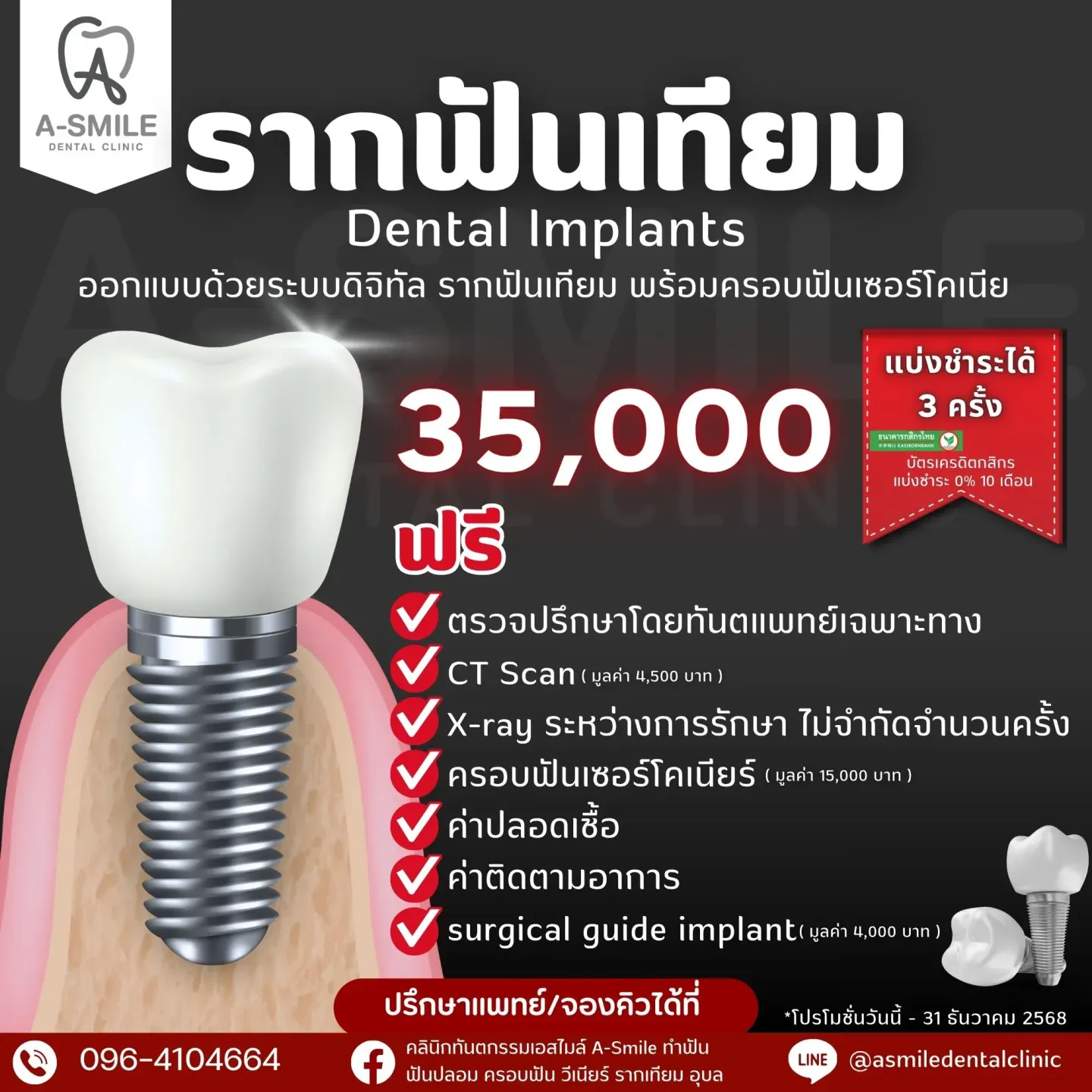 รากฟันเทียมอุบลโดยทันตแพทย์ผู้เชี่ยวชาญ