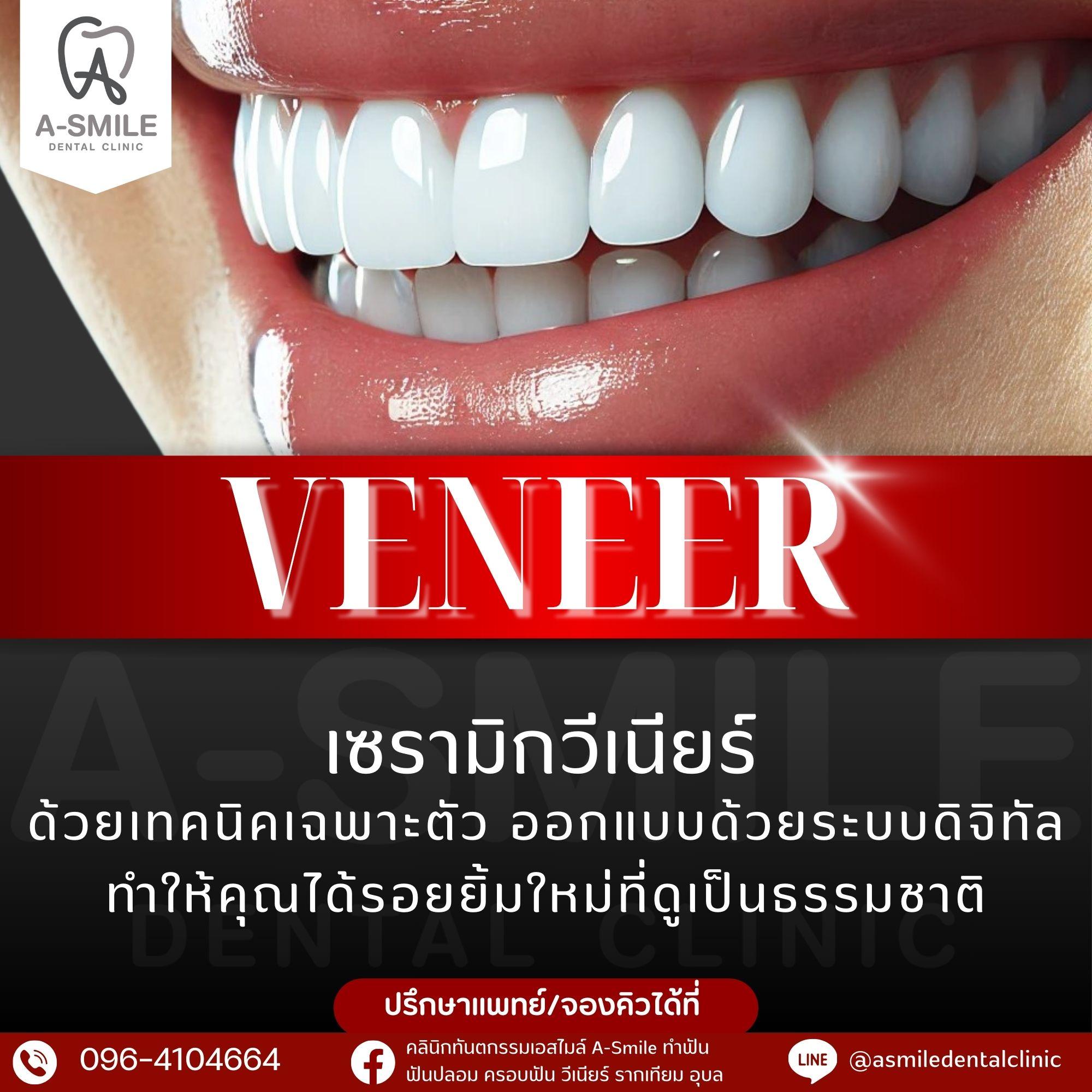 โปรโมชั่น เซรามิกวีเนียร์ คลินิกทันตกรรม เอสไมล์ อุบล