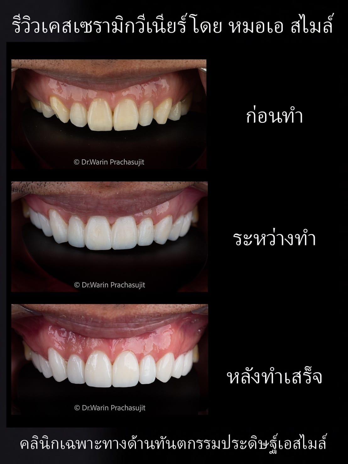 รีวิวเคสเซรามิควีเนียร์ 10 ซี่บน