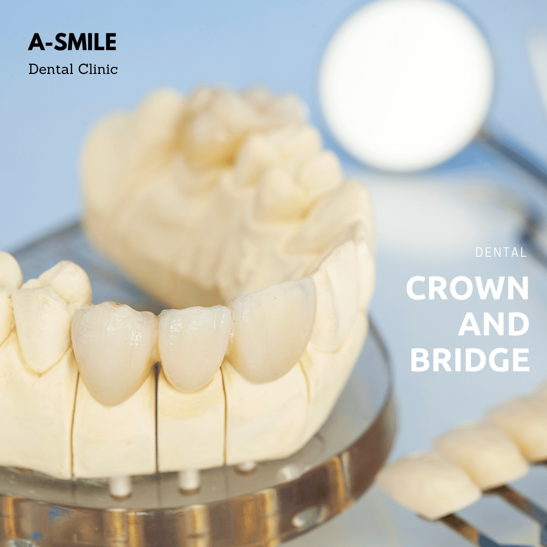 ครอบฟัน สะพานฟัน อุบล โดย หมอเอ สไมล์